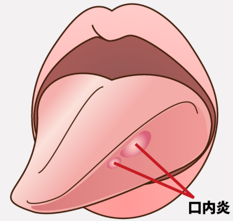 口内炎治療も行っています | ブログ | Copy 春日井市 村瀬歯科